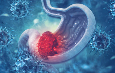 Stomach cancer