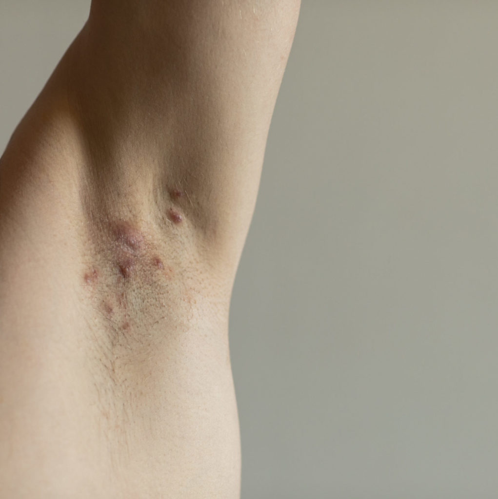 Hidradenitis Suppurativa