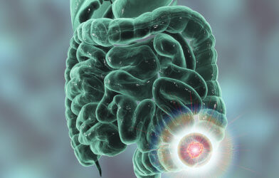 Colorectal cancer