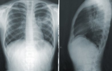 Pneumonia