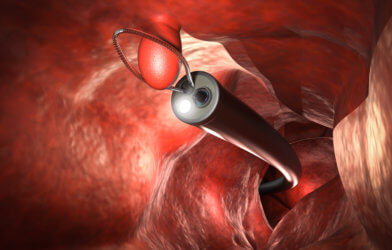 Colonoscopy