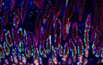 Stomach tissue infected with Helicobacter bacteria